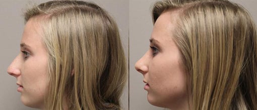 rhinoplasty before and after photos by kryger institute of plastic surgery in thousand oaks ca