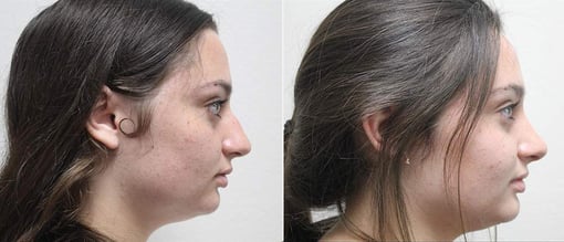 rhinoplasty before and after photos by kryger institute of plastic surgery in thousand oaks ca
