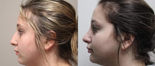 rhinoplasty before and after photos by kryger institute of plastic surgery in thousand oaks ca