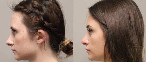 rhinoplasty before and after photos by kryger institute of plastic surgery in thousand oaks ca