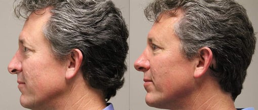 rhinoplasty before and after photos by kryger institute of plastic surgery in thousand oaks ca