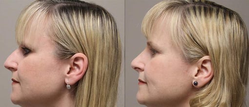 rhinoplasty before and after photos by kryger institute of plastic surgery in thousand oaks ca