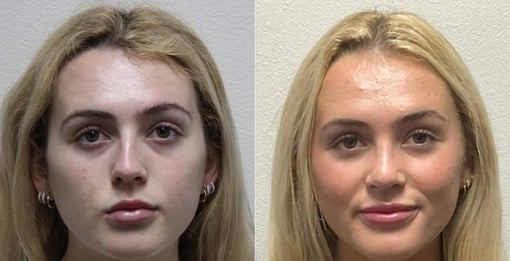 rhinoplasty before and after photos by kryger institute of plastic surgery in thousand oaks ca
