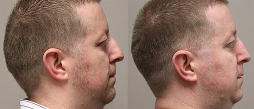 rhinoplasty before and after photos by kryger institute of plastic surgery in thousand oaks ca