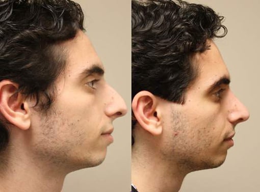 rhinoplasty before and after photos by kryger institute of plastic surgery in thousand oaks ca
