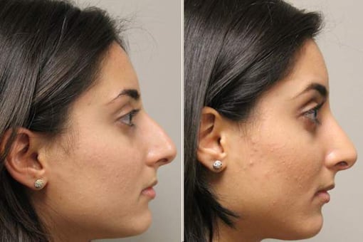 rhinoplasty before and after photos by kryger institute of plastic surgery in thousand oaks ca