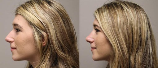 rhinoplasty before and after photos by kryger institute of plastic surgery in thousand oaks ca