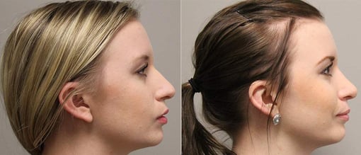 rhinoplasty before and after photos by kryger institute of plastic surgery in thousand oaks ca