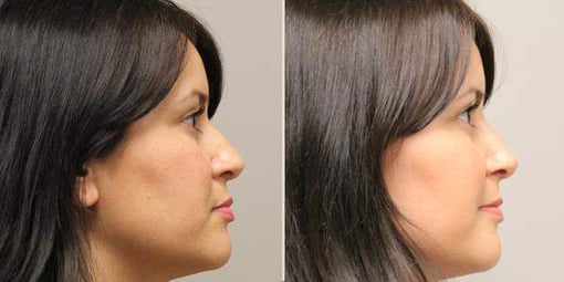 rhinoplasty before and after photos by kryger institute of plastic surgery in thousand oaks ca