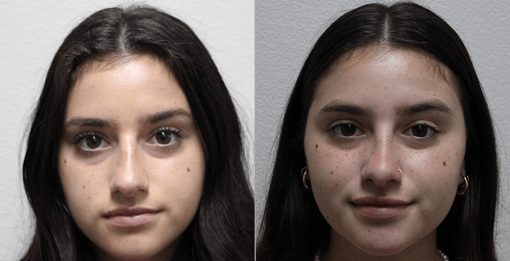 rhinoplasty before and after photos by kryger institute of plastic surgery in thousand oaks ca