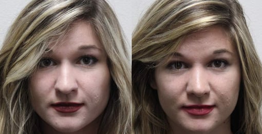 rhinoplasty before and after photos by kryger institute of plastic surgery in thousand oaks ca