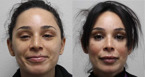 rhinoplasty before and after photos by kryger institute of plastic surgery in thousand oaks ca