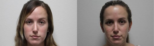 rhinoplasty before and after photos by kryger institute of plastic surgery in thousand oaks ca