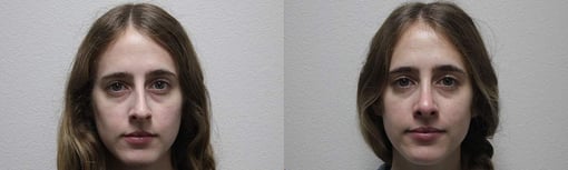 rhinoplasty before and after photos by kryger institute of plastic surgery in thousand oaks ca