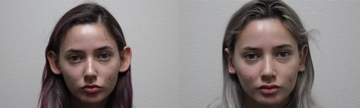 rhinoplasty before and after photos by kryger institute of plastic surgery in thousand oaks ca