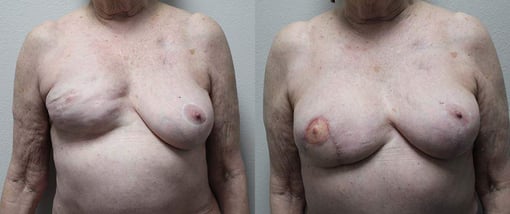 revision reconstruction before and after photos by kryger institute of plastic surgery in thousand oaks ca