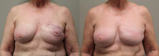 revision reconstruction before and after photos by kryger institute of plastic surgery in thousand oaks ca