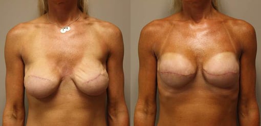 revision reconstruction before and after photos by kryger institute of plastic surgery in thousand oaks ca
