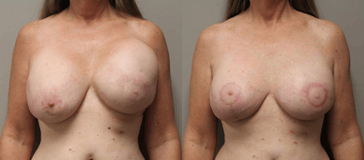 revision reconstruction before and after photos by kryger institute of plastic surgery in thousand oaks ca