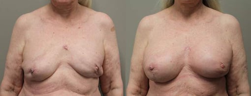 revision reconstruction before and after photos by kryger institute of plastic surgery in thousand oaks ca