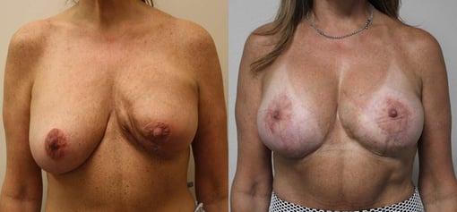 revision reconstruction before and after photos by kryger institute of plastic surgery in thousand oaks ca