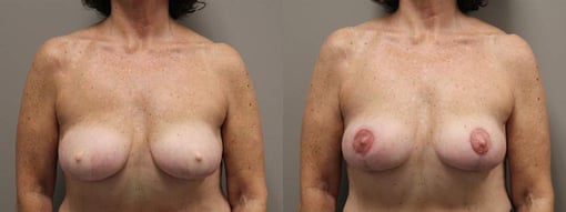 revision reconstruction before and after photos by kryger institute of plastic surgery in thousand oaks ca