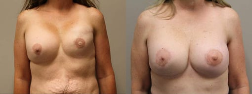 revision reconstruction before and after photos by kryger institute of plastic surgery in thousand oaks ca