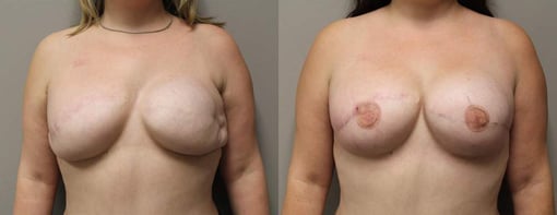 revision reconstruction before and after photos by kryger institute of plastic surgery in thousand oaks ca