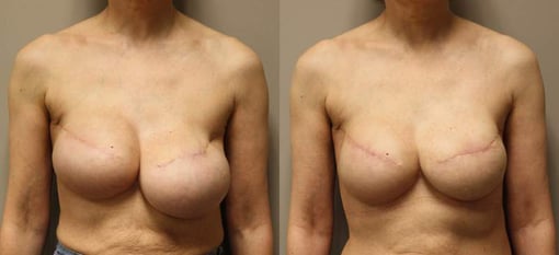 revision reconstruction before and after photos by kryger institute of plastic surgery in thousand oaks ca