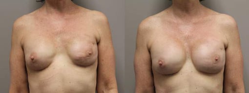 revision reconstruction before and after photos by kryger institute of plastic surgery in thousand oaks ca
