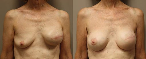 revision reconstruction before and after photos by kryger institute of plastic surgery in thousand oaks ca