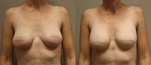 revision reconstruction before and after photos by kryger institute of plastic surgery in thousand oaks ca