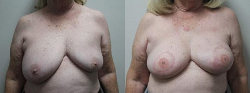 reconstruction with latisimus flap before and after photos by kryger institute of plastic surgery in thousand oaks ca