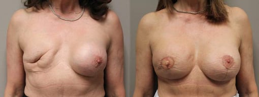 reconstruction with latisimus flap before and after photos by kryger institute of plastic surgery in thousand oaks ca