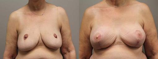 reconstruction with latisimus flap before and after photos by kryger institute of plastic surgery in thousand oaks ca