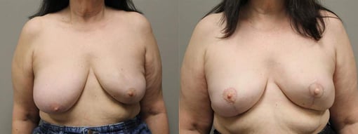 reconstruction with latisimus flap before and after photos by kryger institute of plastic surgery in thousand oaks ca