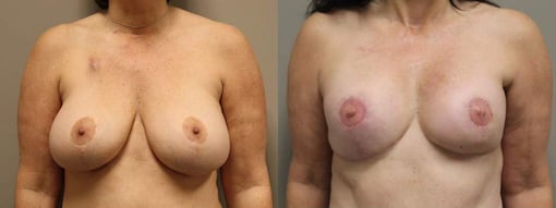 reconstruction with latisimus flap before and after photos by kryger institute of plastic surgery in thousand oaks ca