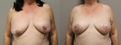 reconstruction with latisimus flap before and after photos by kryger institute of plastic surgery in thousand oaks ca