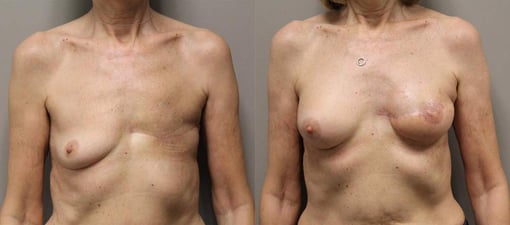 reconstruction with latisimus flap before and after photos by kryger institute of plastic surgery in thousand oaks ca