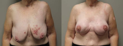 reconstruction with latisimus flap before and after photos by kryger institute of plastic surgery in thousand oaks ca