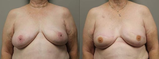 reconstruction with latisimus flap before and after photos by kryger institute of plastic surgery in thousand oaks ca