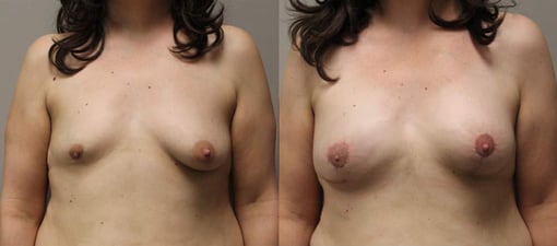 reconstruction with implants before and after photos by kryger institute of plastic surgery in thousand oaks ca