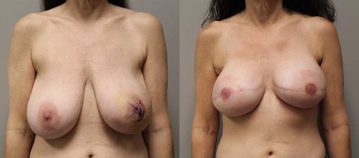 reconstruction with implants before and after photos by kryger institute of plastic surgery in thousand oaks ca