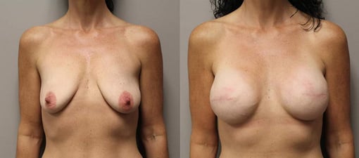 reconstruction with implants before and after photos by kryger institute of plastic surgery in thousand oaks ca