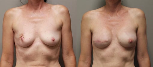 reconstruction with implants before and after photos by kryger institute of plastic surgery in thousand oaks ca