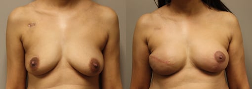reconstruction with implants before and after photos by kryger institute of plastic surgery in thousand oaks ca
