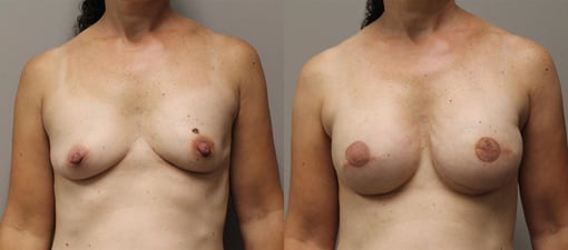 reconstruction with implants before and after photos by kryger institute of plastic surgery in thousand oaks ca