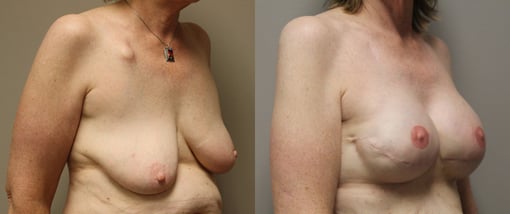 reconstruction with implants before and after photos by kryger institute of plastic surgery in thousand oaks ca