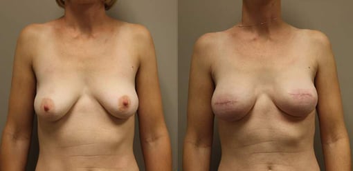 reconstruction with implants before and after photos by kryger institute of plastic surgery in thousand oaks ca