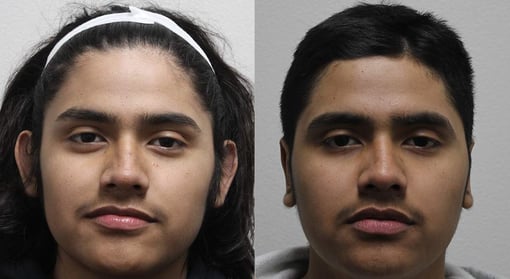otoplasty before and after photos by kryger institute of plastic surgery in thousand oaks ca